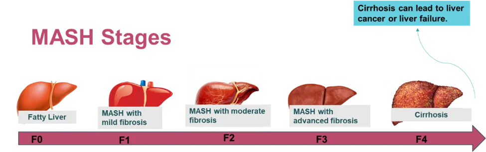 Different Stages of MASH